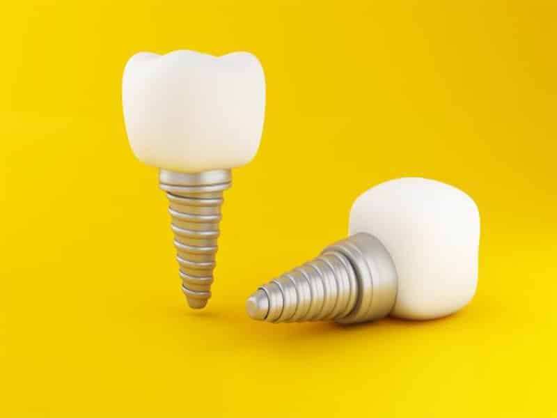 ایمپلنت اوردنچر چیست؟ | فرزانه فرخ نژاد دندانپزشک زیبایی