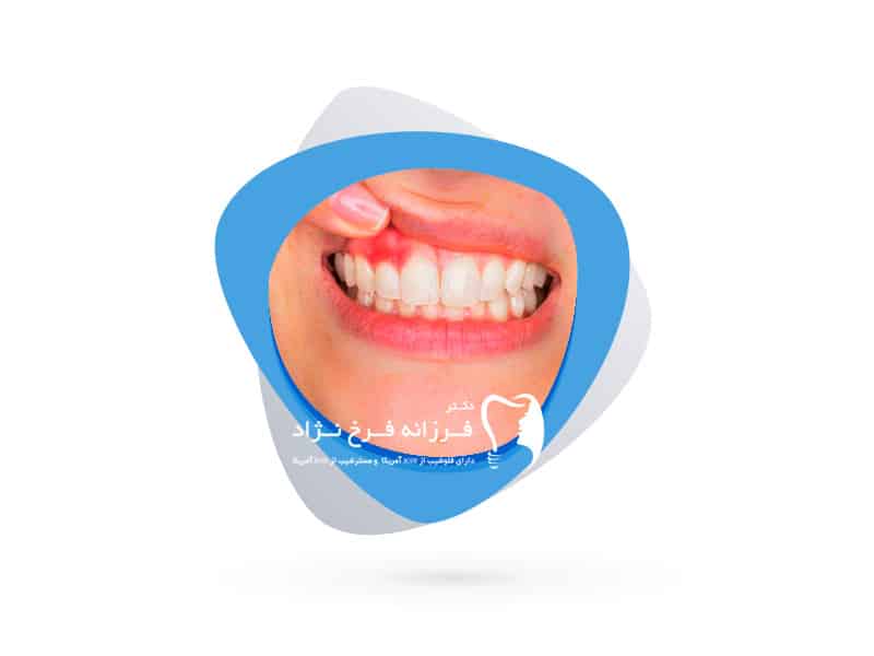 جراحی زیبایی لثه