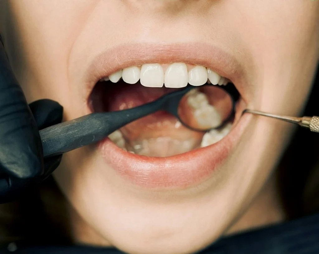 علت سوراخ شدن دندان چیست؟ 6 دلیل و 5 پیشگیری
